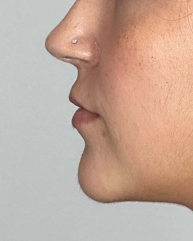 Juvederm Before & After