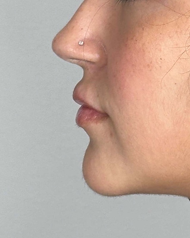 Juvederm Before & After