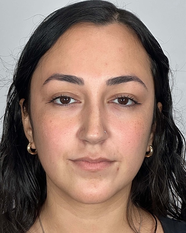 Juvederm Before & After