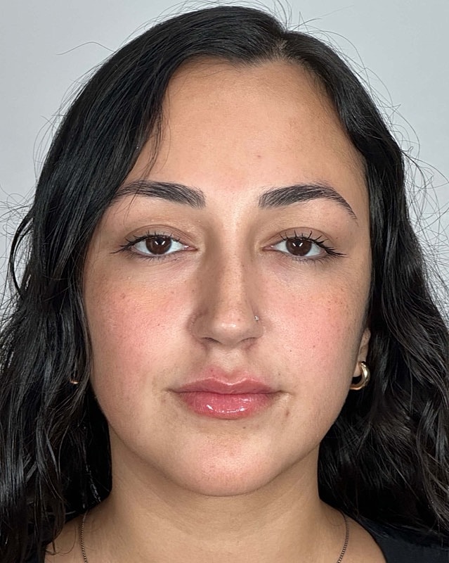 Juvederm Before & After