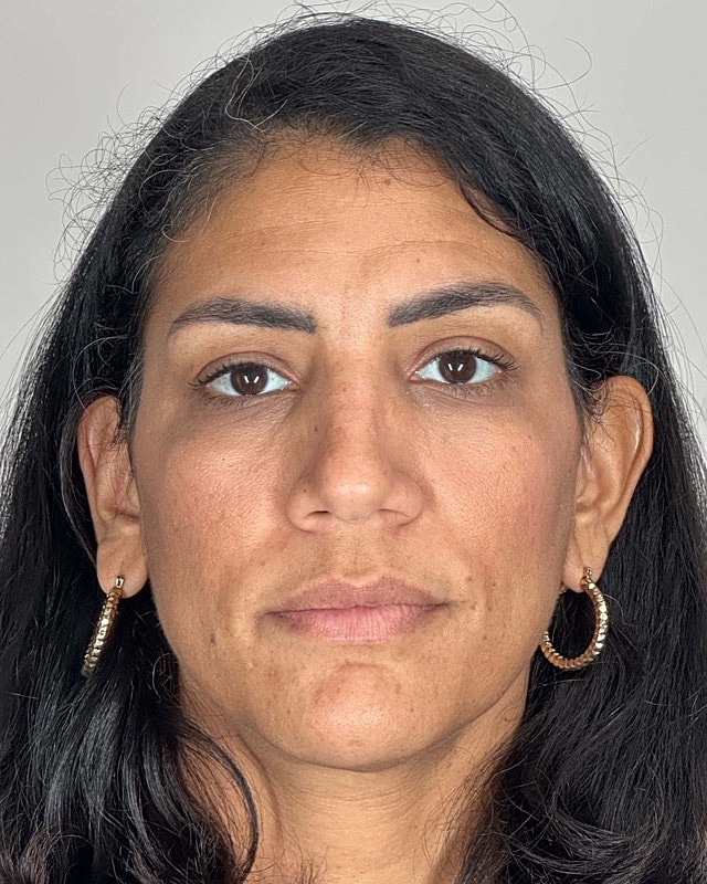 Juvederm Before & After