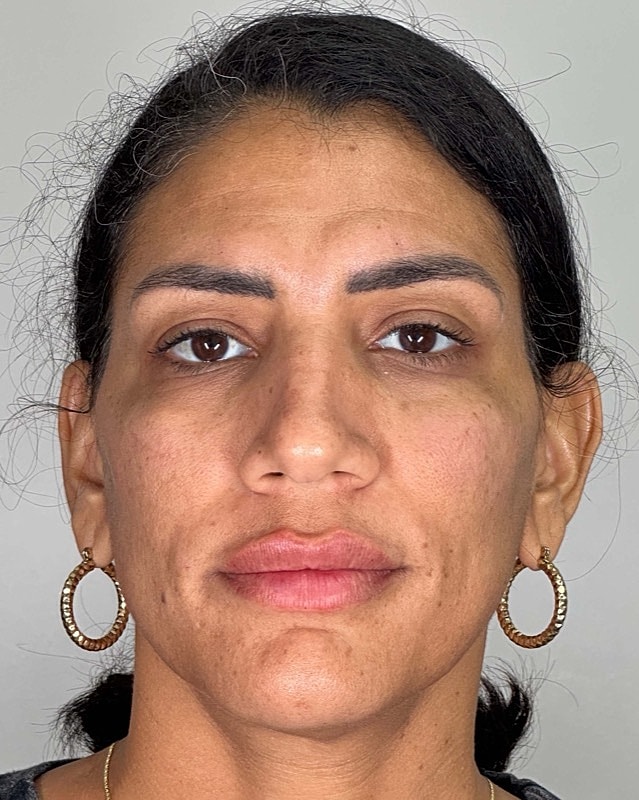 Juvederm Before & After