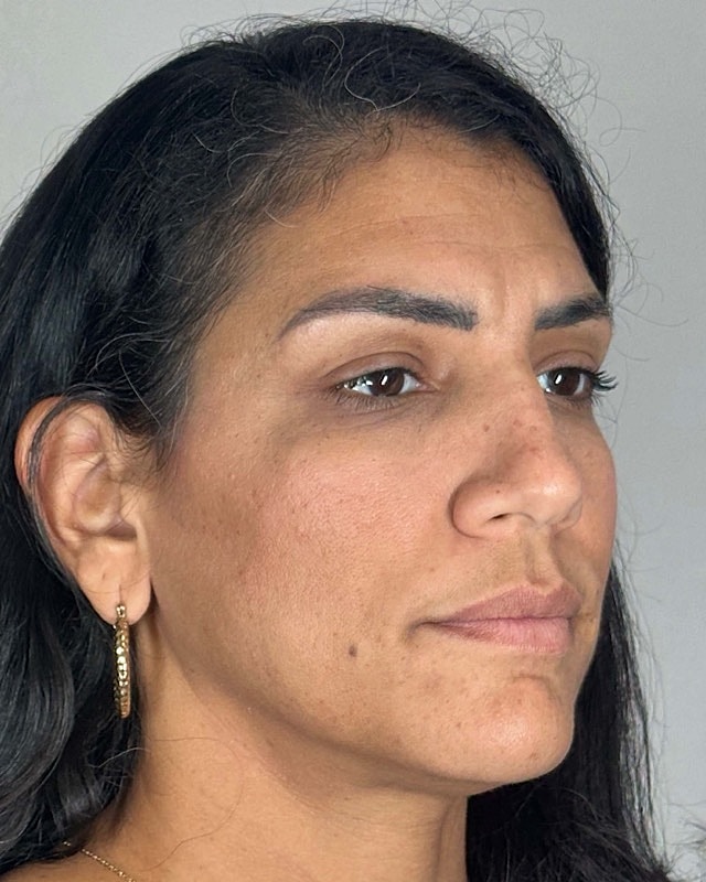 Juvederm Before & After