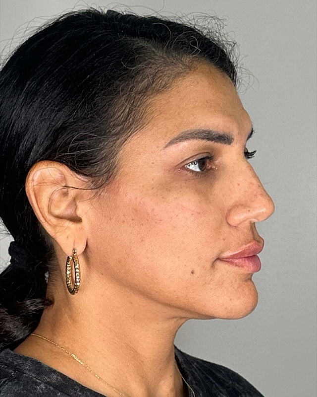 Juvederm Before & After