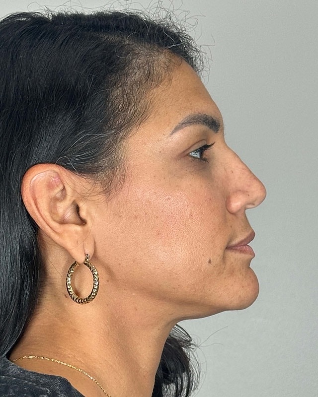 Juvederm Before & After