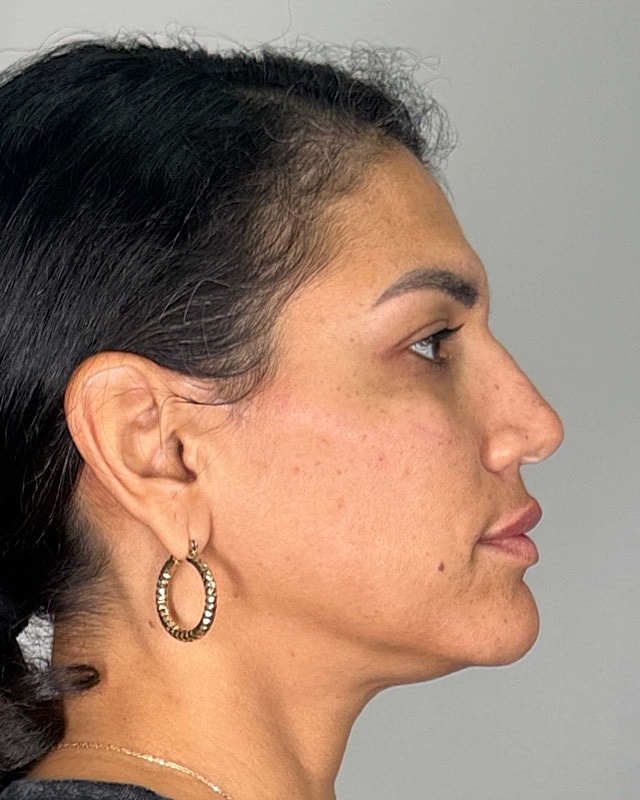 Juvederm Before & After