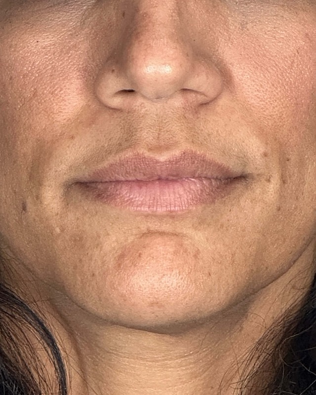Juvederm Before & After