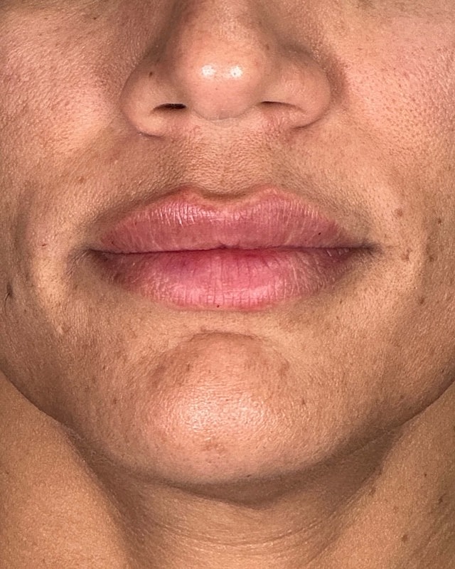 Juvederm Before & After
