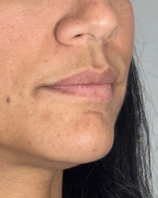 Juvederm Before & After