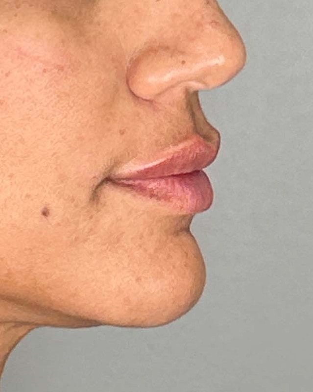 Juvederm Before & After