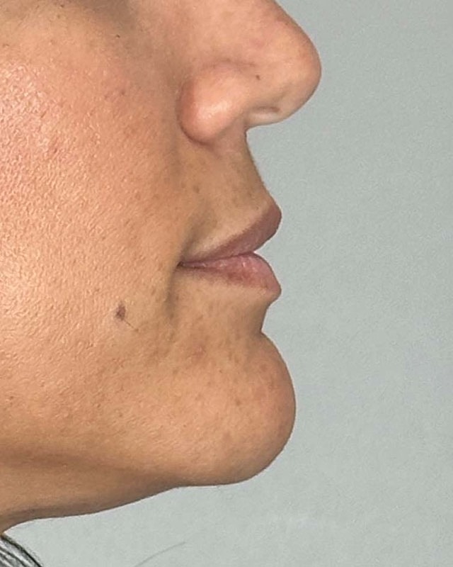 Juvederm Before & After