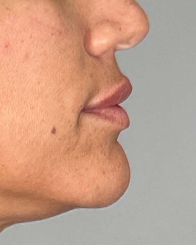 Juvederm Before & After