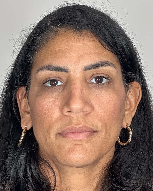 Juvederm Before & After
