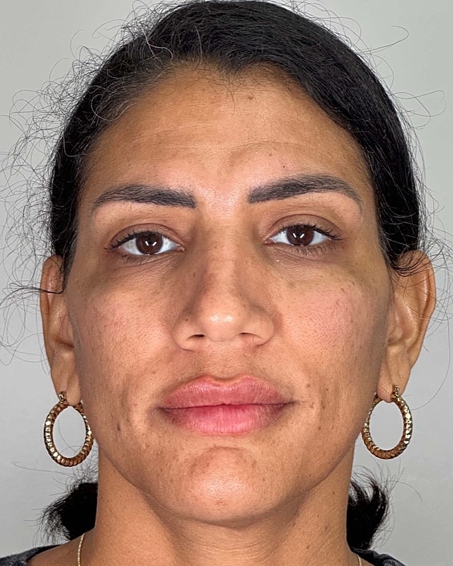 Juvederm Before & After