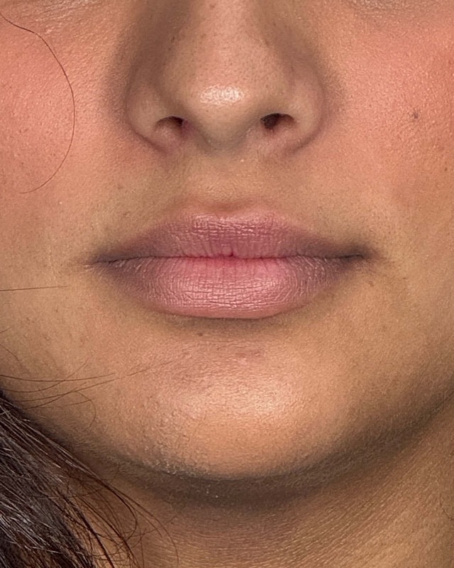 Juvederm Before & After