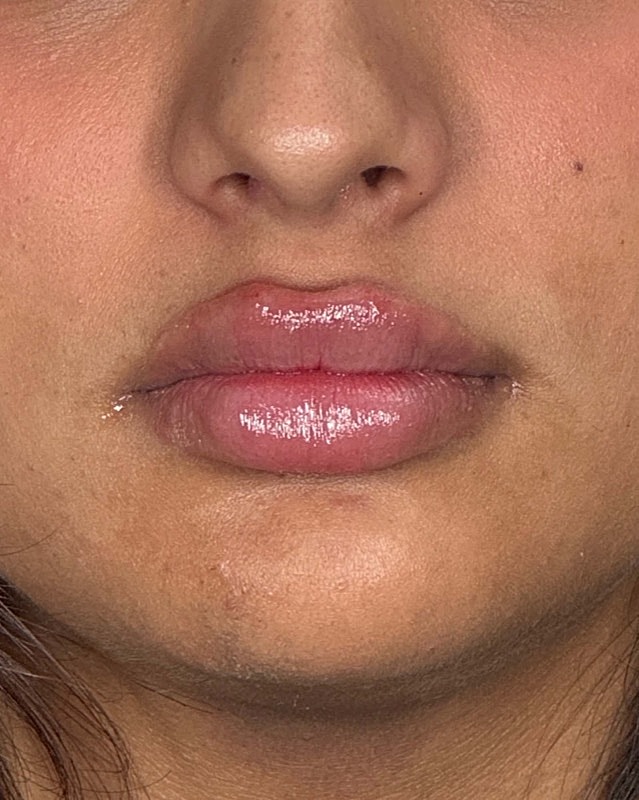 Juvederm Before & After