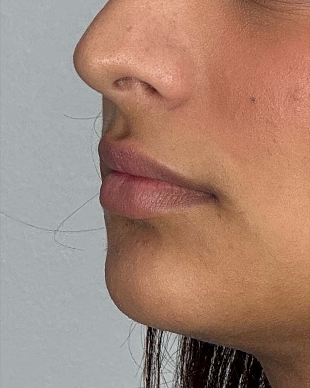 Juvederm Before & After