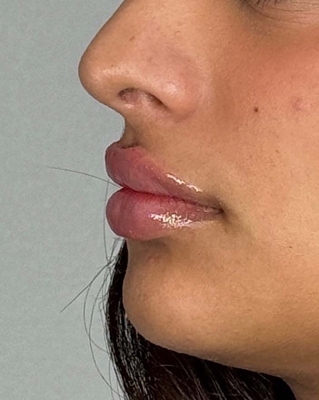 Juvederm Before & After