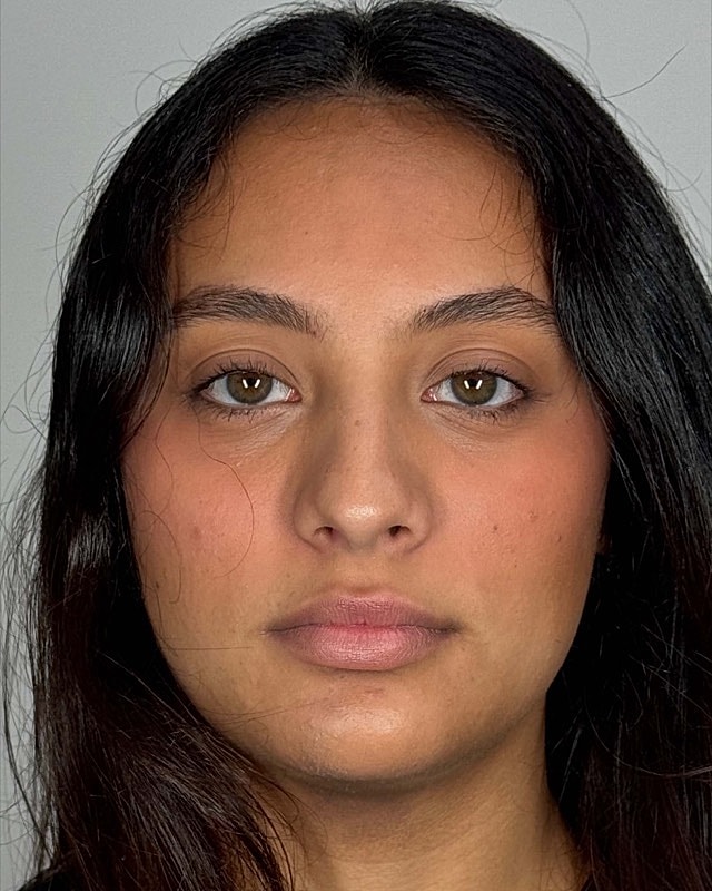 Juvederm Before & After
