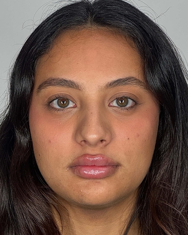 Juvederm Before & After