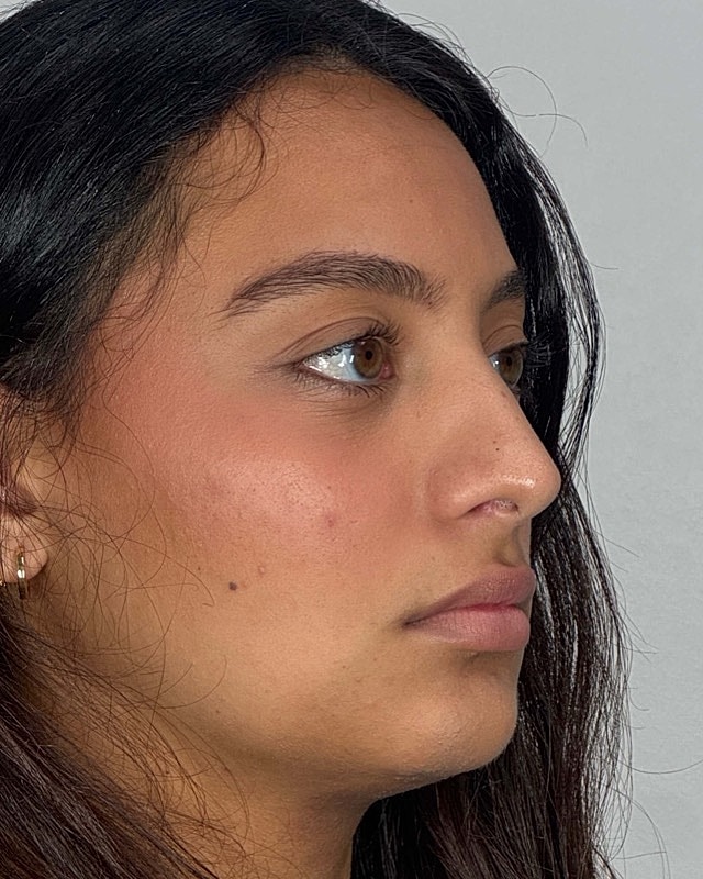 Juvederm Before & After