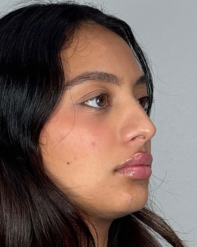 Juvederm Before & After
