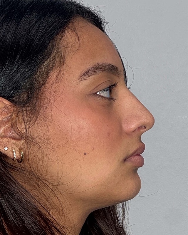 Juvederm Before & After