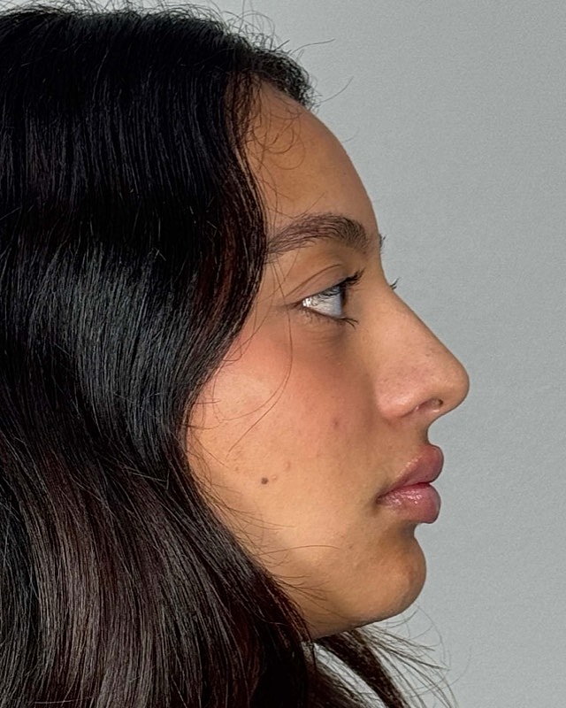 Juvederm Before & After