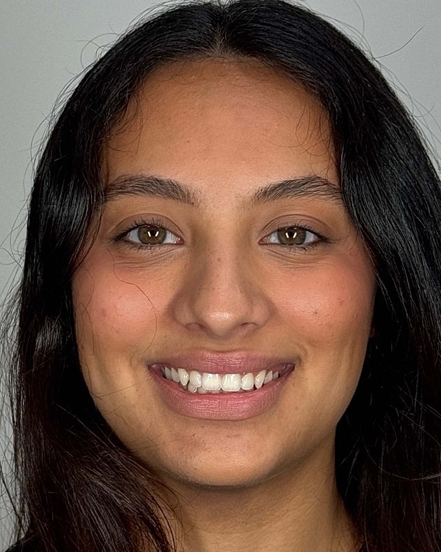 Juvederm Before & After