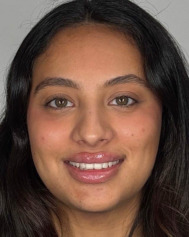 Juvederm Before & After