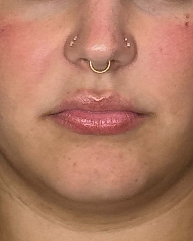 Juvederm Before & After