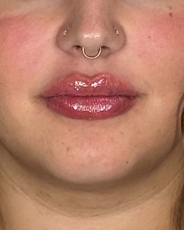 Juvederm Before & After