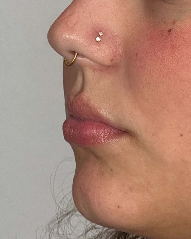 Juvederm Before & After