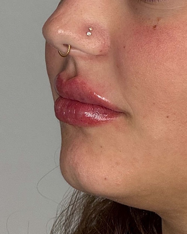 Juvederm Before & After