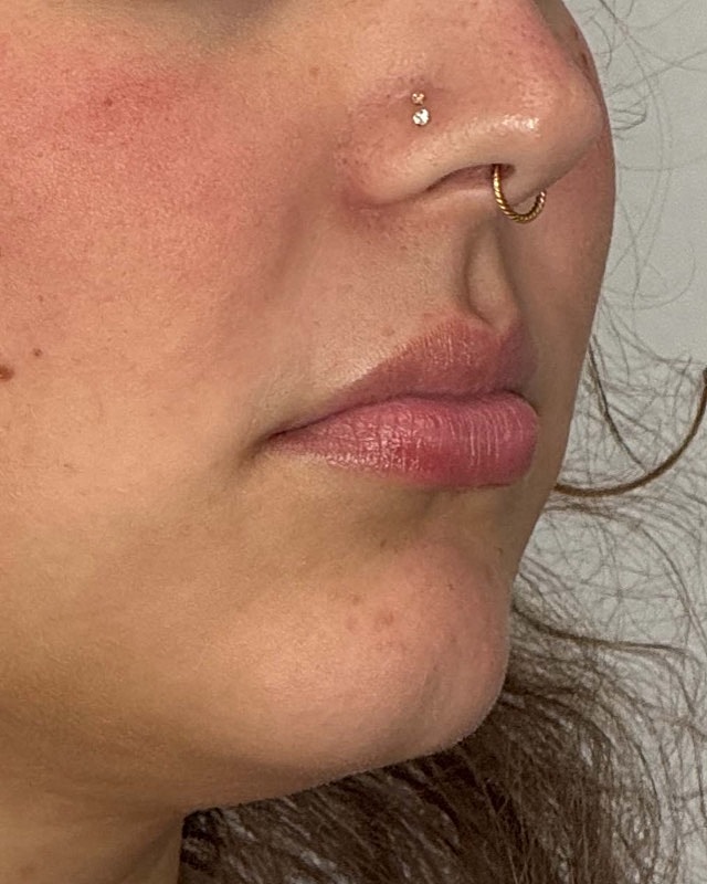 Juvederm Before & After
