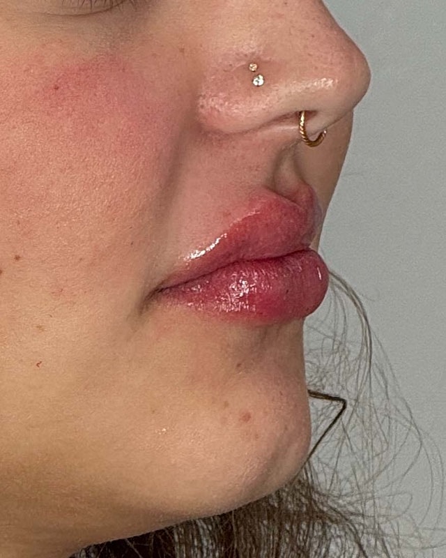 Juvederm Before & After