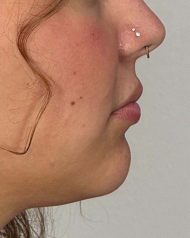 Juvederm Before & After