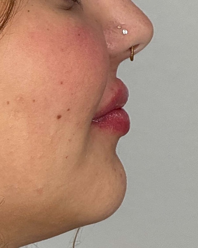 Juvederm Before & After