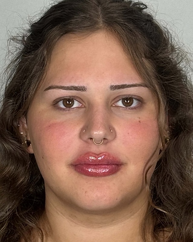 Juvederm Before & After
