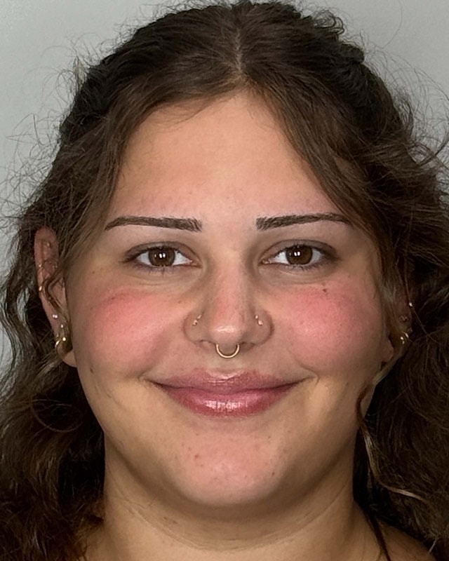Juvederm Before & After