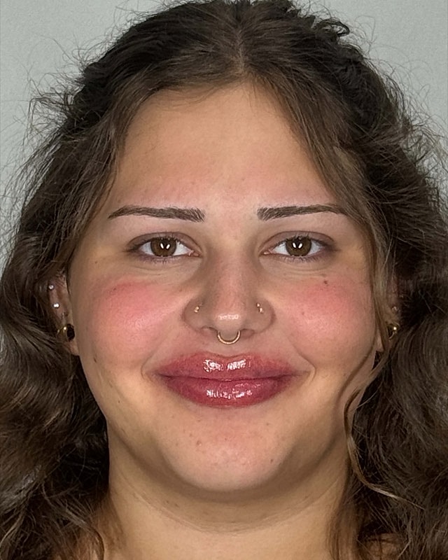 Juvederm Before & After
