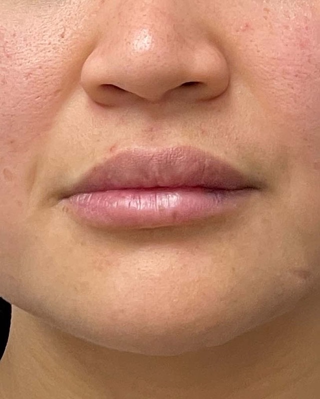 Juvederm Before & After