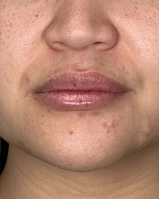Juvederm Before & After
