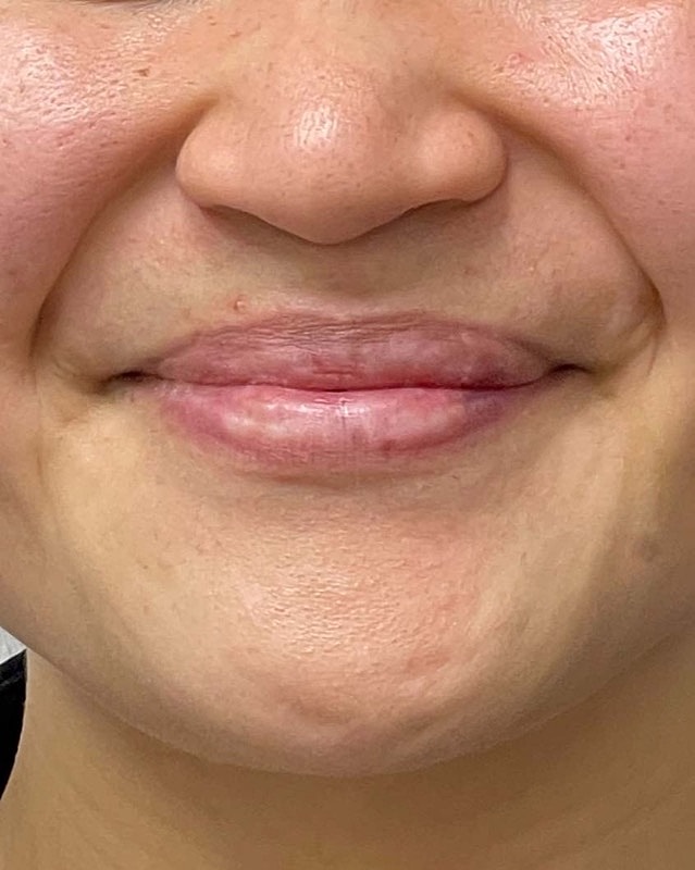 Juvederm Before & After