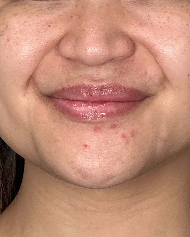 Juvederm Before & After
