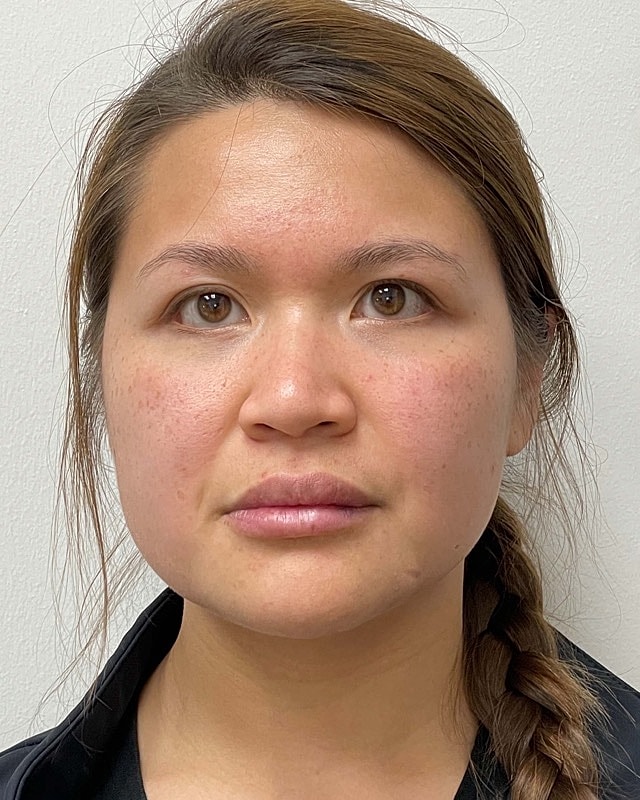 Juvederm Before & After