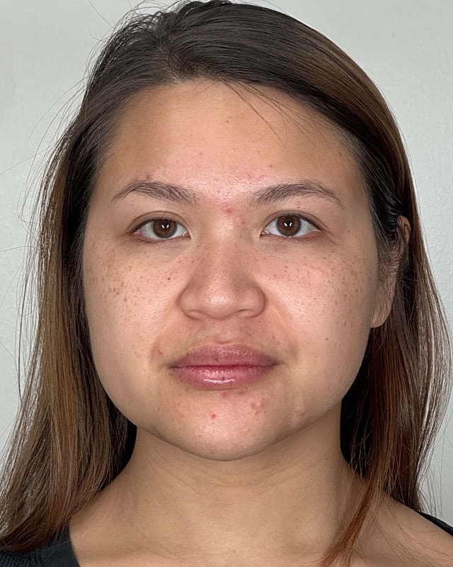 Juvederm Before & After