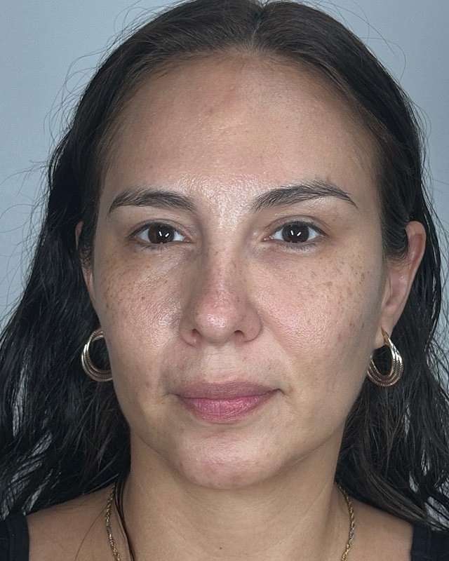 Juvederm Before & After