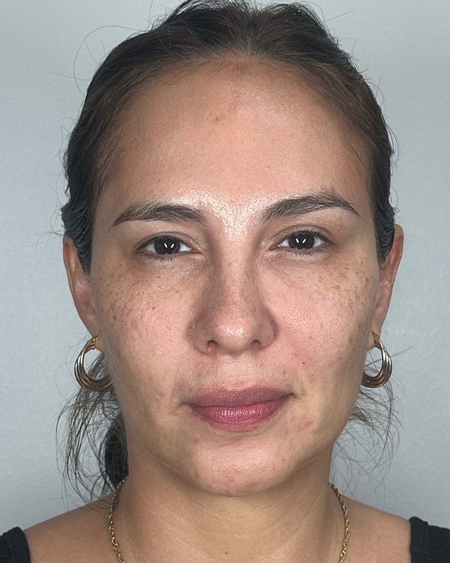 Juvederm Before & After