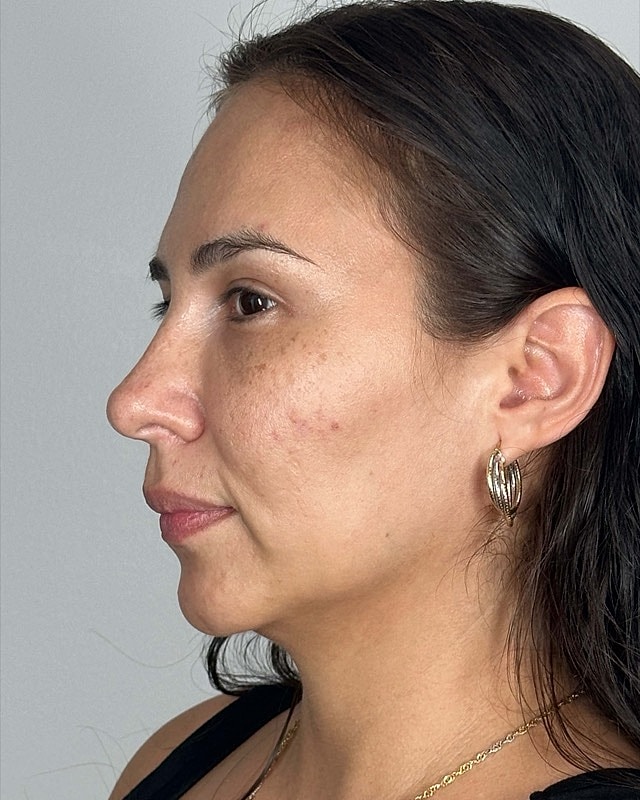 Juvederm Before & After